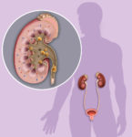 Descriptive illustration of male human figure with kidney system and enlarged kidney where stones or kidney stones can be clearly seen.