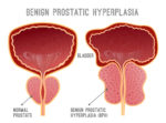 comparison of normal prostate and one with bph.